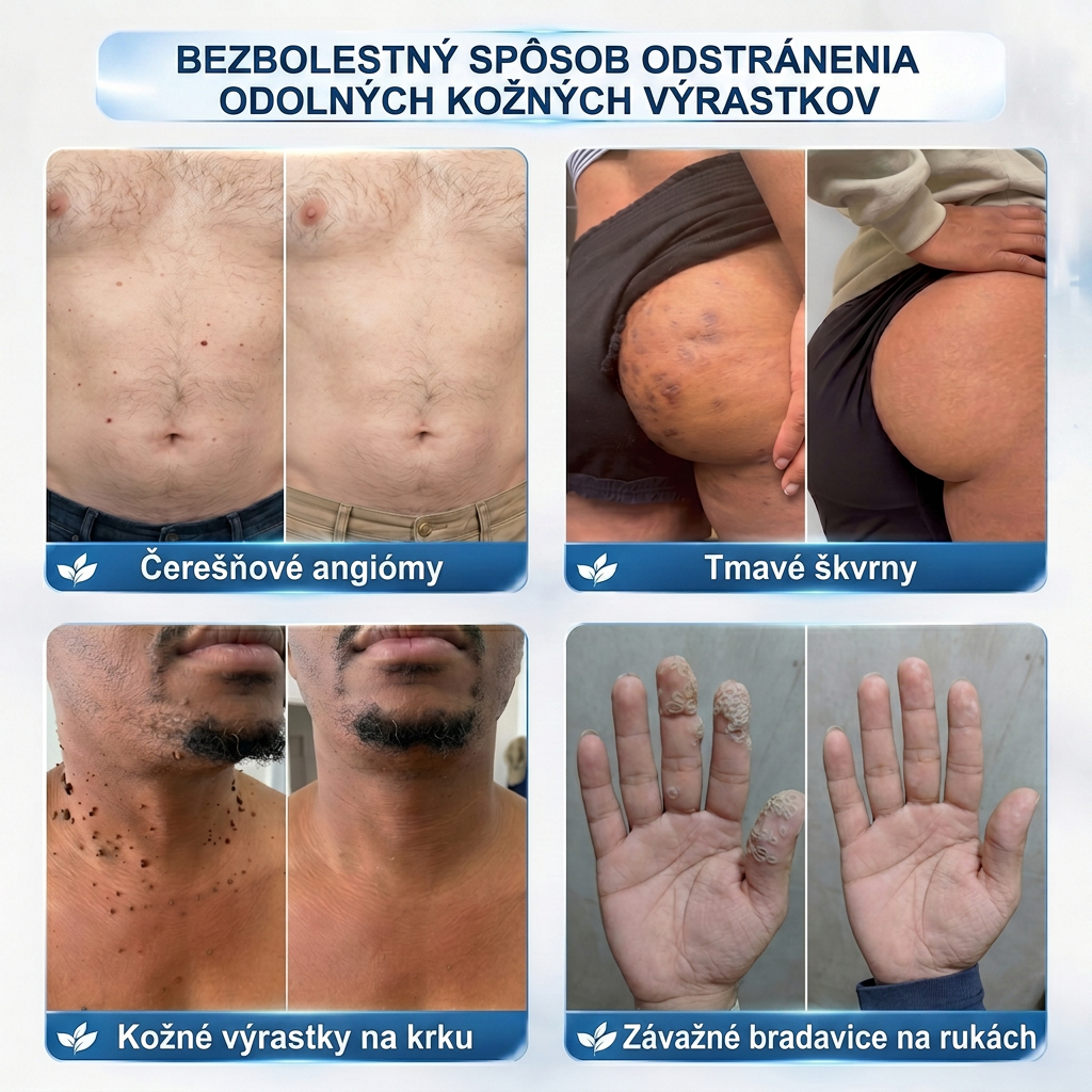 👌𝑶𝒇𝒊𝒄𝒊á𝒍𝒏𝒚 𝒐𝒃𝒄𝒉𝒐𝒅 ✅️ | 𝐇𝐈𝐒𝐊𝐈𝐍® 7-𝒅ň𝒐𝒗ý 𝒑𝒓í𝒑𝒓𝒂𝒗𝒐𝒌 𝒏𝒂 𝒐𝒅𝒔𝒕𝒓á𝒏𝒆𝒏𝒊𝒆 𝒌𝒐ž𝒏ý𝒄𝒉 𝒗ý𝒓𝒂𝒔𝒕𝒌𝒐𝒗 𝒂 𝒑𝒊𝒈𝒎𝒆𝒏𝒕𝒐𝒗ý𝒄𝒉 š𝒌𝒗ŕ𝒏👩‍⚕️ (𝒃𝒆𝒛 𝒃𝒐𝒍𝒆𝒔𝒕𝒊, 𝒃𝒆𝒛 𝒋𝒂𝒛𝒊𝒆𝒗, 𝒑𝒓𝒆𝒔𝒏ý 𝒓𝒐𝒍𝒍-𝒐𝒏 𝒂𝒑𝒍𝒊𝒌á𝒕𝒐𝒓) 🔥