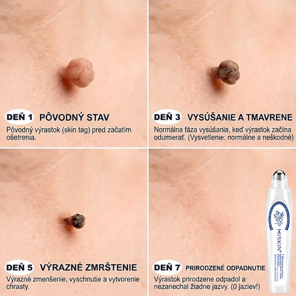 👌𝑶𝒇𝒊𝒄𝒊á𝒍𝒏𝒚 𝒐𝒃𝒄𝒉𝒐𝒅 ✅️ | 𝐇𝐈𝐒𝐊𝐈𝐍® 7-𝒅ň𝒐𝒗ý 𝒑𝒓í𝒑𝒓𝒂𝒗𝒐𝒌 𝒏𝒂 𝒐𝒅𝒔𝒕𝒓á𝒏𝒆𝒏𝒊𝒆 𝒌𝒐ž𝒏ý𝒄𝒉 𝒗ý𝒓𝒂𝒔𝒕𝒌𝒐𝒗 𝒂 𝒑𝒊𝒈𝒎𝒆𝒏𝒕𝒐𝒗ý𝒄𝒉 š𝒌𝒗ŕ𝒏👩‍⚕️ (𝒃𝒆𝒛 𝒃𝒐𝒍𝒆𝒔𝒕𝒊, 𝒃𝒆𝒛 𝒋𝒂𝒛𝒊𝒆𝒗, 𝒑𝒓𝒆𝒔𝒏ý 𝒓𝒐𝒍𝒍-𝒐𝒏 𝒂𝒑𝒍𝒊𝒌á𝒕𝒐𝒓) 🔥